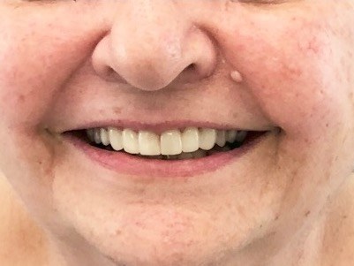 Laser teeth whitening near me