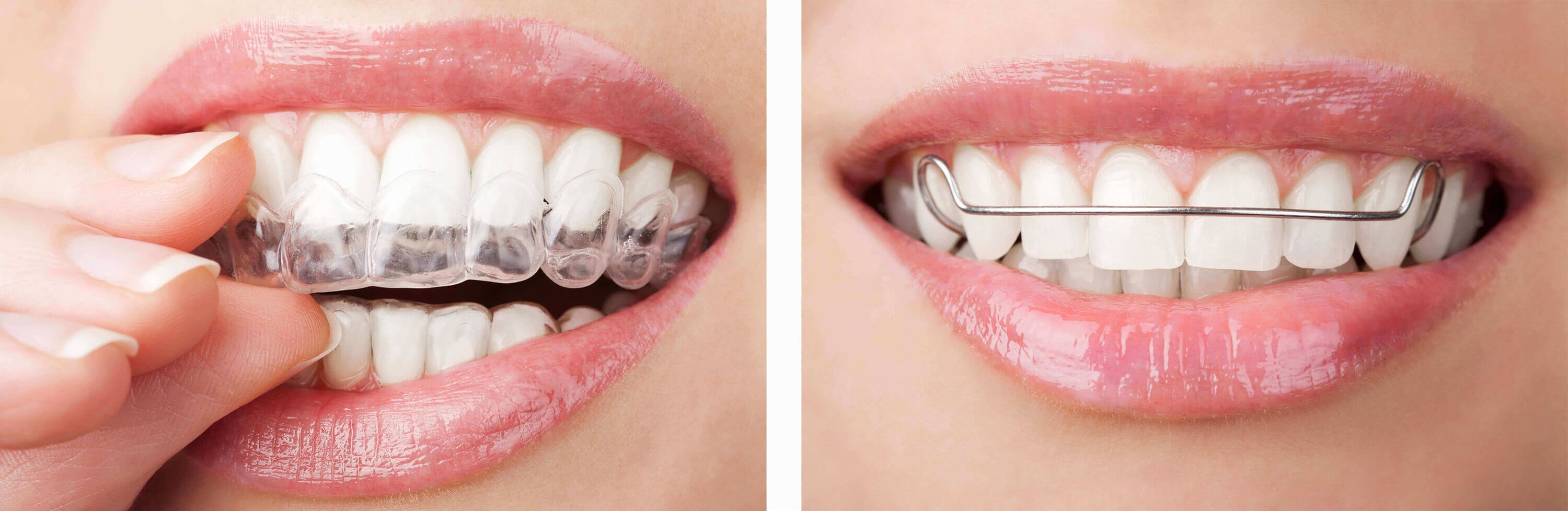 Retainers In Las Vegas, NV | The Art Of Braces