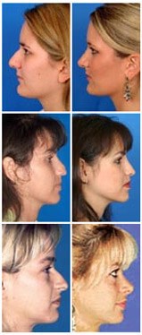 Rhinoplasty Houston Tx Dr Russell Kridel