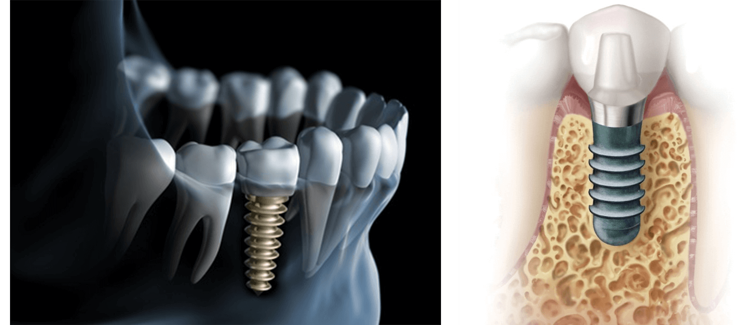 implanty-zebowe-millennium-surgical